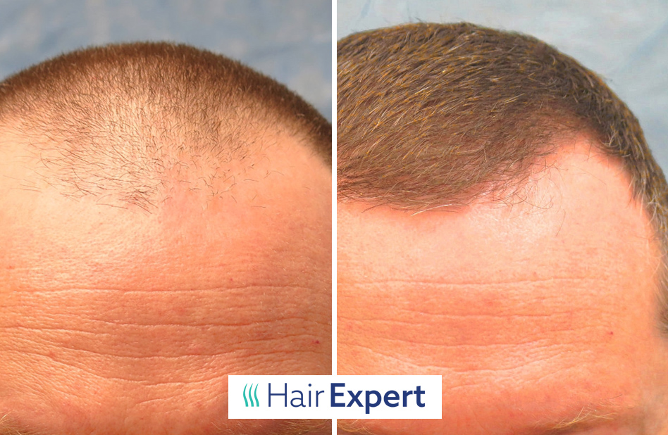 Mužská androgenní alopecie je řešitelná – trvale problém vyřeší transplantace vlasů